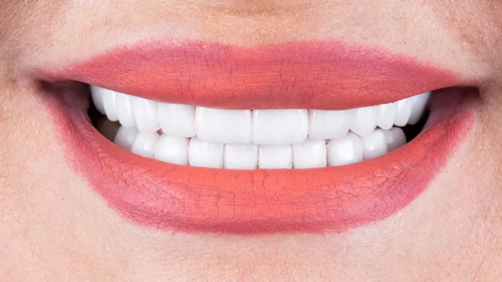 cost of porcelain veneers in turkey