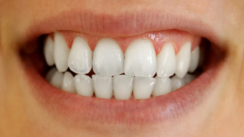 symptoms of translucent teeth