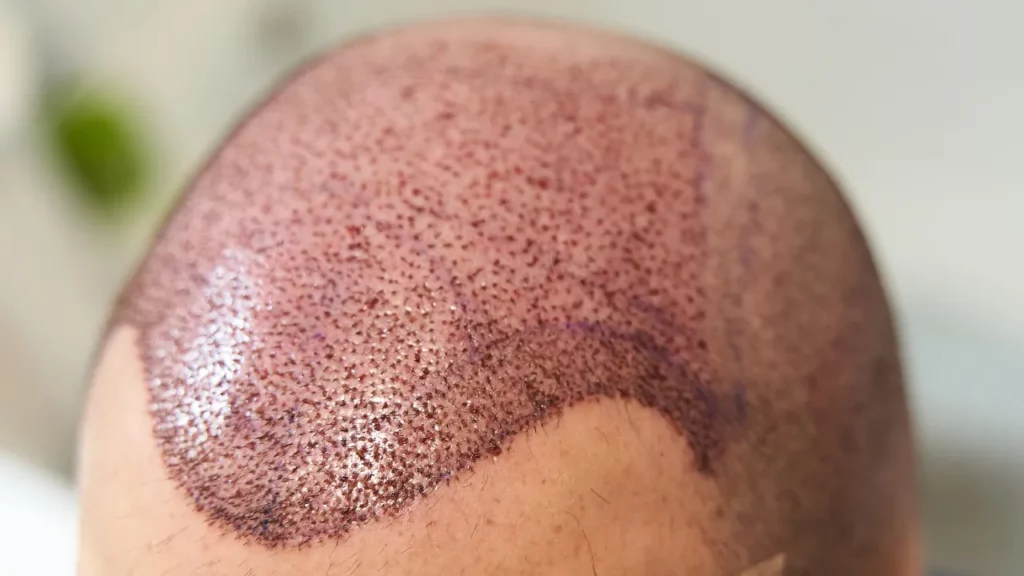 1800 grafts hair transplant basics