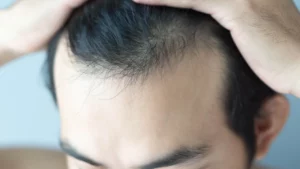 hair transplant 4 months of hair growth