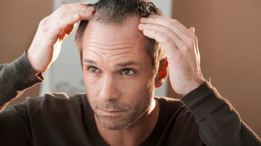 how to prevent hair loss after hair transplant