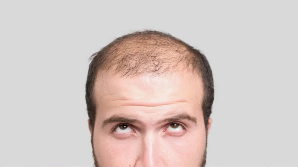 hair transplant after 2 months