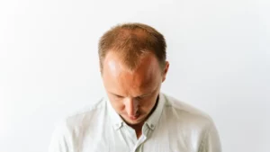 hair transplant growth stages guide