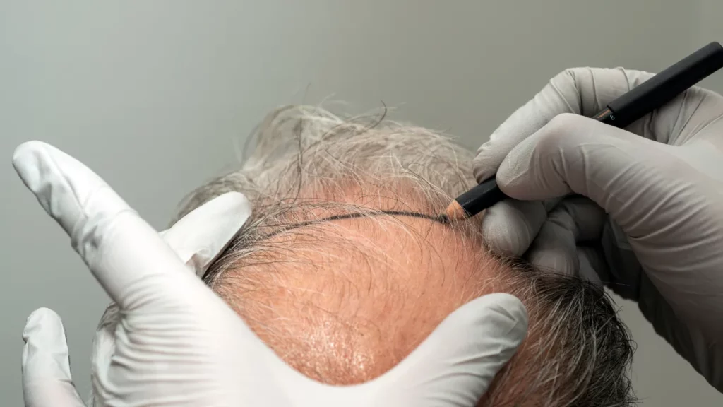 hair transplant success rate