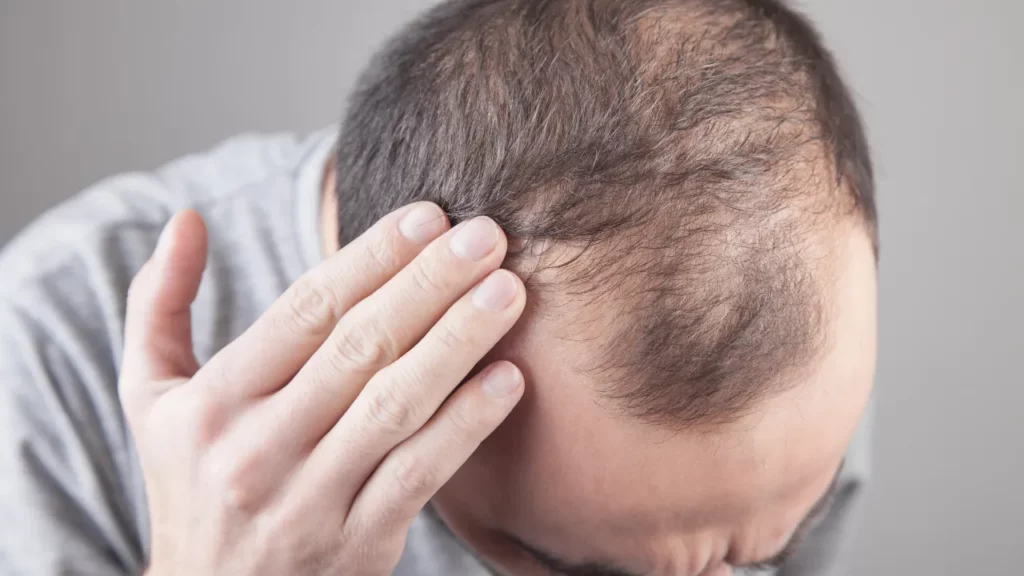 side effects of hair transplant