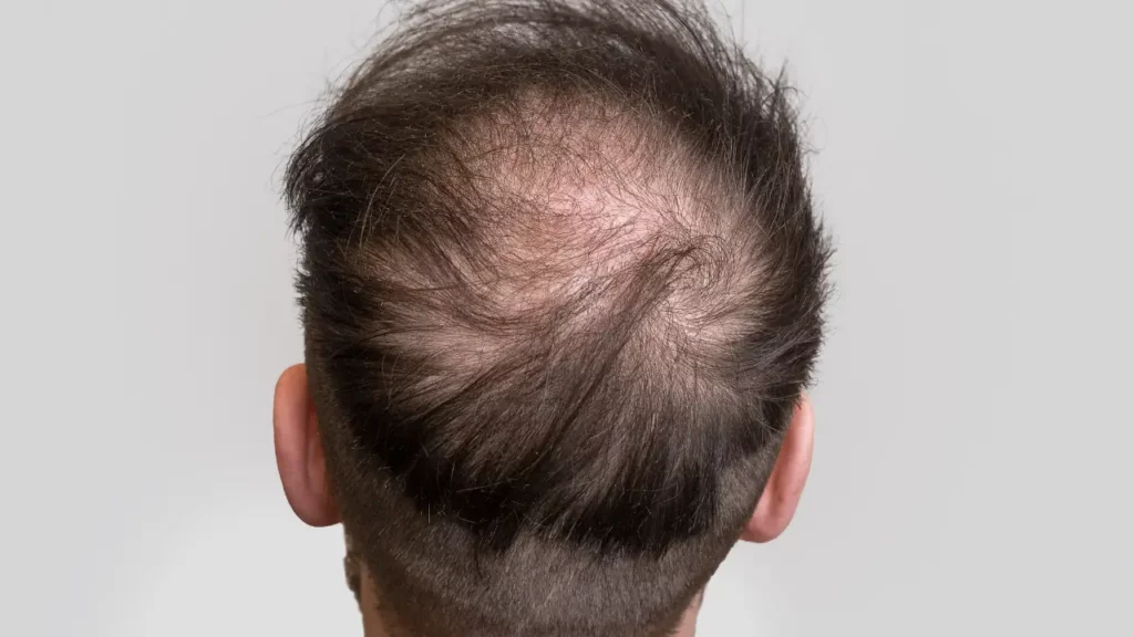 best crown hair transplant clinic