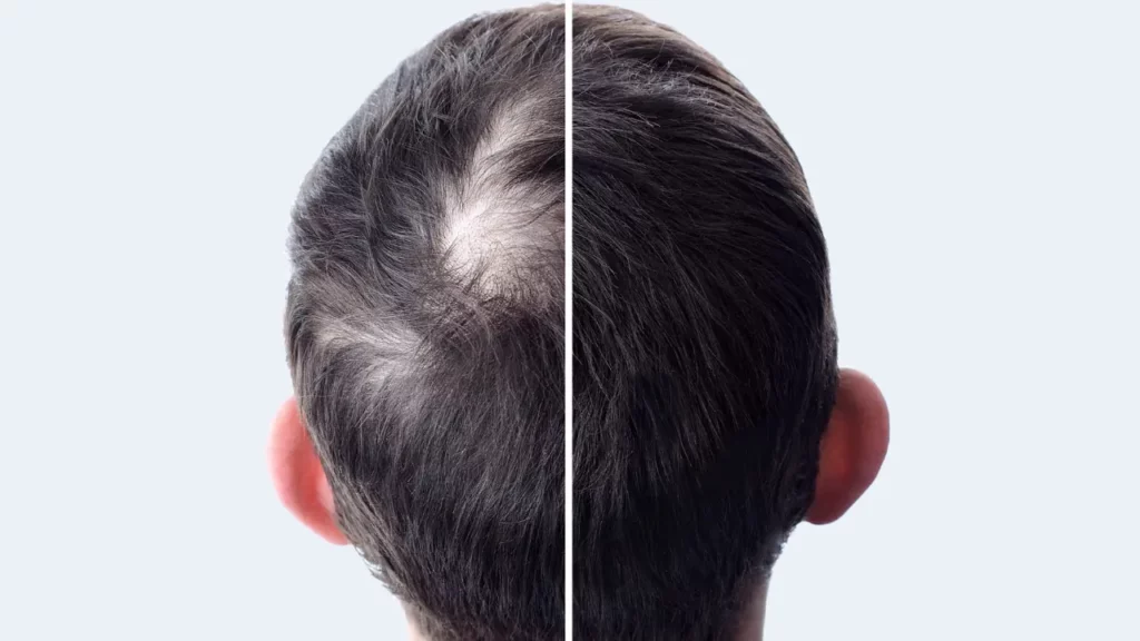 crown hair transplant benefits