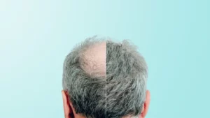 crown hair transplant treatment