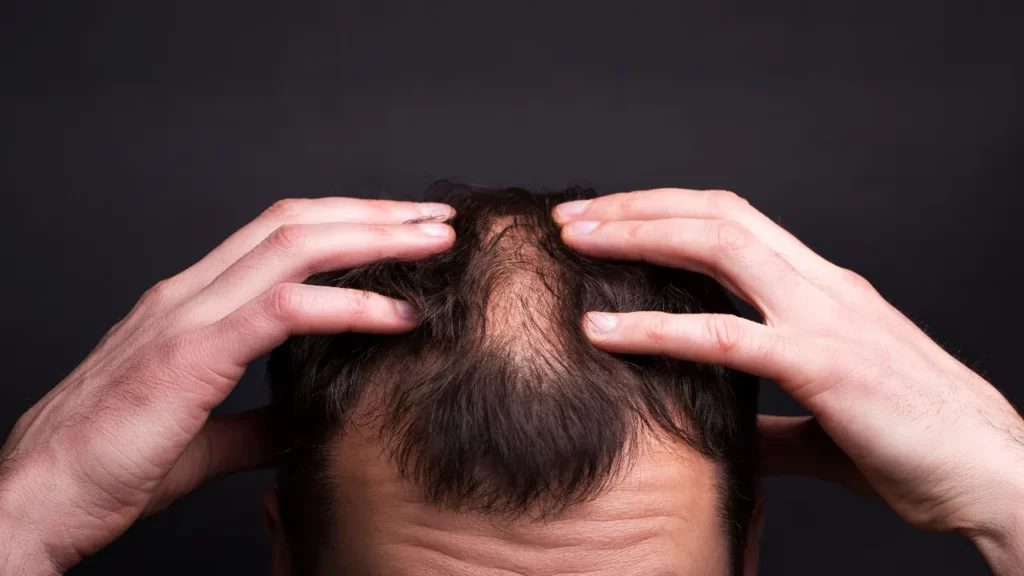 bad hair transplant possibilities