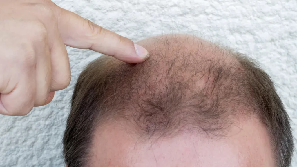 hair transplant shock loss timeline