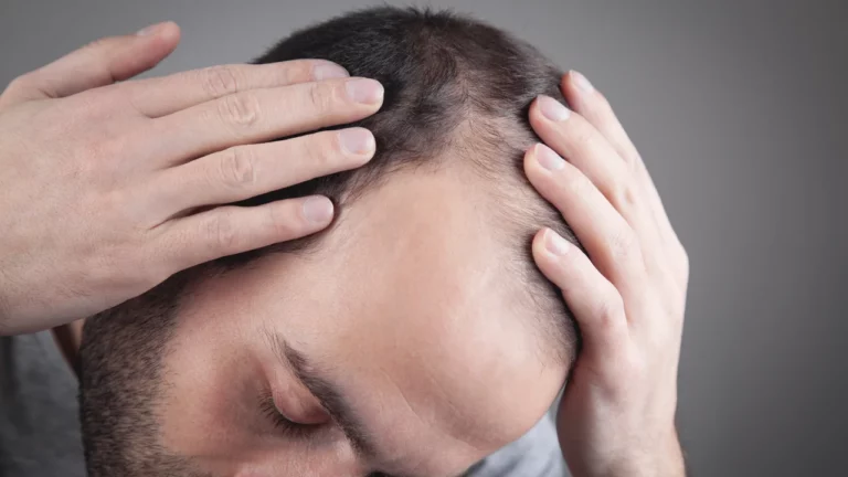infected hair transplant follicle