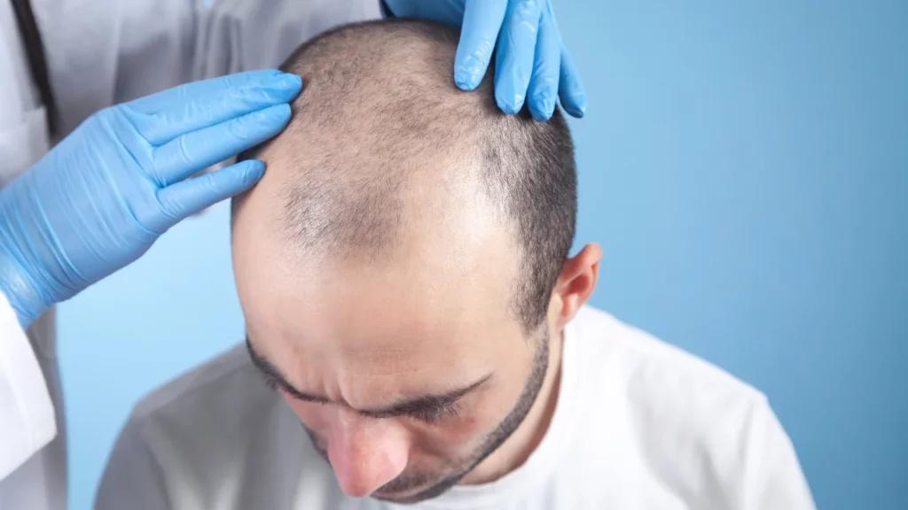 initial donor area after hair transplant