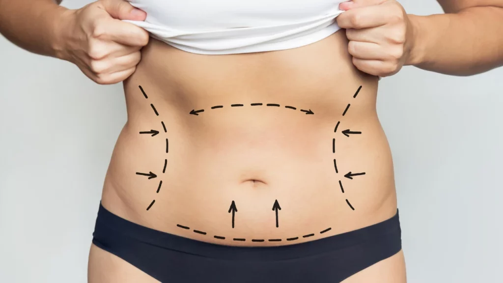 hard lump under tummy tuck incision