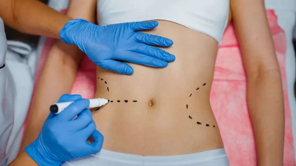 step by step liposuction